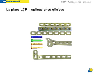 LCP – Aplicaciones clínicas
La placa LCP – Aplicaciones clínicas
 