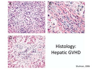 Histology:
Hepatic GVHD
Shulman, 2006
 