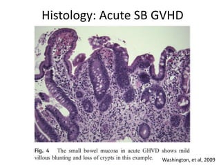 Histology: Acute SB GVHD
Washington, et al, 2009
 