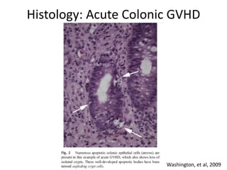 Histology: Acute Colonic GVHD
Washington, et al, 2009
 