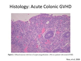 Histology: Acute Colonic GVHD
Ross, et al, 2008
 