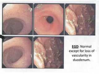 EGD: Normal
except for loss of
vascularity in
duodenum.
 