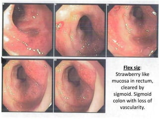 Flex sig:
Strawberry like
mucosa in rectum,
cleared by
sigmoid. Sigmoid
colon with loss of
vascularity.
 