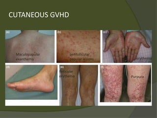 CUTANEOUS GVHD
Maculopapular
exanthema
perifollicular
papular lesions erythema
Purpura
Reticular
erythema
 
