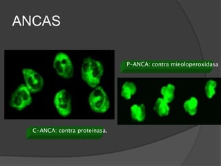 ANCAS

                               P-ANCA: contra mieoloperoxidasa




  C-ANCA: contra proteinasa.
 