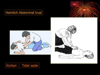 Korban  :  Tidak sadar Heimlich Abdominal trust 