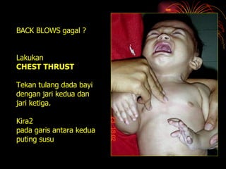 BACK BLOWS gagal ? Lakukan  CHEST THRUST Tekan tulang dada bayi dengan jari kedua dan  jari ketiga. Kira2 pada garis antara kedua puting susu 