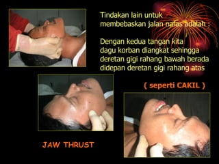 JAW THRUST Tindakan lain untuk membebaskan jalan nafas adalah : Dengan kedua tangan kita dagu korban diangkat sehingga deretan gigi rahang bawah berada didepan deretan gigi rahang atas ( seperti CAKIL ) 