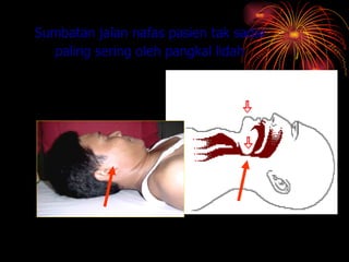 Sumbatan jalan nafas pasien tak sadar    paling sering oleh pangkal lidah 