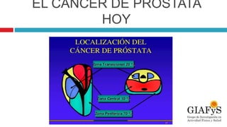 EL CÁNCER DE PRÓSTATA
HOY
 