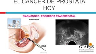 EL CÁNCER DE PRÓSTATA
HOY
DIAGNÓSTICO: ECOGRAFÍA TRANSRRECTAL
.
 
