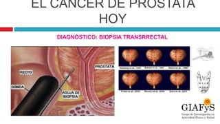 EL CÁNCER DE PRÓSTATA
HOY
DIAGNÓSTICO: BIOPSIA TRANSRRECTAL
 