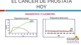 EL CÁNCER DE PRÓSTATA
HOY
DIAGNÓSTICO: FLUJOMETRÍA
 