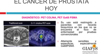 EL CÁNCER DE PRÓSTATA
HOY
DIAGNÓSTICO: PET COLINA, PET Ga68 PSMA
 Su uso está restringido a
pacientes con recaída
bioquímica en los que no se
encuentra el foco de
enfermedad por pruebas
convencionales
 Altamente sensibles y
especificas, especialmente
Ga68PSMA
 