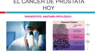 EL CÁNCER DE PRÓSTATA
HOY
DIAGNÓSTICO: ANATOMÍA PATOLÓGICA
 