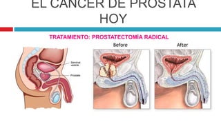 EL CÁNCER DE PRÓSTATA
HOY
TRATAMIENTO: PROSTATECTOMÍA RADICAL
 