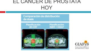 EL CÁNCER DE PRÓSTATA
HOY
 