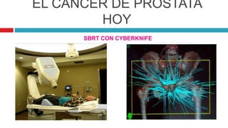 EL CÁNCER DE PRÓSTATA
HOY
SBRT CON CYBERKNIFE
 