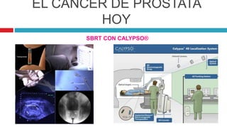 EL CÁNCER DE PRÓSTATA
HOY
SBRT CON CALYPSO®
 