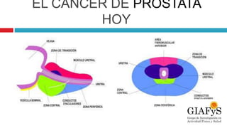 EL CÁNCER DE PRÓSTATA
HOY
 