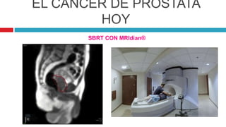 EL CÁNCER DE PRÓSTATA
HOY
SBRT CON MRIdian®
 