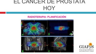 EL CÁNCER DE PRÓSTATA
HOY
RADIOTERAPIA: PLANIFICACIÓN
 