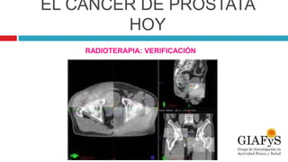 EL CÁNCER DE PRÓSTATA
HOY
RADIOTERAPIA: VERIFICACIÓN
 