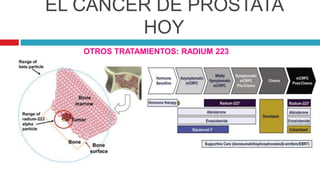 EL CÁNCER DE PRÓSTATA
HOY
OTROS TRATAMIENTOS: RADIUM 223
 