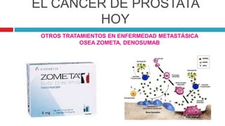 EL CÁNCER DE PRÓSTATA
HOY
OTROS TRATAMIENTOS EN ENFERMEDAD METASTÁSICA
OSEA ZOMETA, DENOSUMAB
 