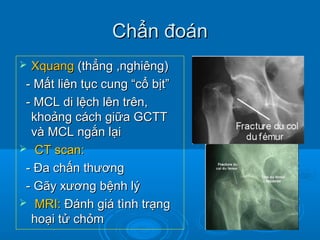 Chẩn đoánChẩn đoán
 XquangXquang (thẳng ,nghiêng)(thẳng ,nghiêng)
- Mất liên tục cung “cổ bịt”- Mất liên tục cung “cổ bịt”
- MCL di lệch lên trên,- MCL di lệch lên trên,
khoảng cách giữa GCTTkhoảng cách giữa GCTT
và MCL ngắn lạivà MCL ngắn lại
 CT scan:CT scan:
- Đa chấn thương- Đa chấn thương
- Gãy xương bệnh lý- Gãy xương bệnh lý
 MRI:MRI: Đánh giá tình trạngĐánh giá tình trạng
hoại tử chỏmhoại tử chỏm
 