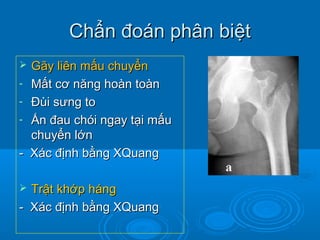 Chẩn đoán phân biệtChẩn đoán phân biệt
 Gãy liên mấu chuyểnGãy liên mấu chuyển
- Mất cơ năng hoàn toànMất cơ năng hoàn toàn
- Đùi sưng toĐùi sưng to
- Ấn đau chói ngay tại mấuẤn đau chói ngay tại mấu
chuyển lớnchuyển lớn
- Xác định bằng XQuang- Xác định bằng XQuang
 Trật khớp hángTrật khớp háng
- Xác định bằng XQuang- Xác định bằng XQuang
 
