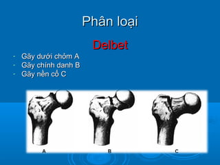 Phân loạiPhân loại
DelbetDelbet
- Gãy dưới chỏm AGãy dưới chỏm A
- Gãy chính danh BGãy chính danh B
- Gãy nền cổ CGãy nền cổ C
 