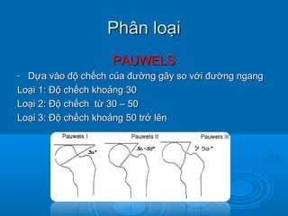 Phân loạiPhân loại
PAUWELSPAUWELS
- Dựa vào độ chếch của đường gãy so với đường ngangDựa vào độ chếch của đường gãy so với đường ngang
Loại 1: Độ chếch khoảng 30Loại 1: Độ chếch khoảng 30
Loại 2: Độ chếch từ 30 – 50Loại 2: Độ chếch từ 30 – 50
Loại 3: Độ chếch khoảng 50 trở lênLoại 3: Độ chếch khoảng 50 trở lên
 
