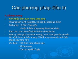 Các phương pháp điều trịCác phương pháp điều trị
A. Kết hợp xương:A. Kết hợp xương:
1.1. KHX nhiều đinh dưới màng tăng sángKHX nhiều đinh dưới màng tăng sáng
- Phương tiện: đinh Knowles, vis xốp đk khoảng 5-6mmPhương tiện: đinh Knowles, vis xốp đk khoảng 5-6mm
- Số lượng: + 3 đinh: Tam giácSố lượng: + 3 đinh: Tam giác
+ hoặc 4 đinh: song song thành hình hộp+ hoặc 4 đinh: song song thành hình hộp
- Rạch da: 1cm cho mỗi đinh/ 4-5cm cho toàn bộRạch da: 1cm cho mỗi đinh/ 4-5cm cho toàn bộ
- Định vị: điểm giữa của thân xương, 2 cm dưới gờ mấu chuyểnĐịnh vị: điểm giữa của thân xương, 2 cm dưới gờ mấu chuyển
lớn, đinh hợp với thân xương đùi 45lớn, đinh hợp với thân xương đùi 4500
song song nền nhà (bànsong song nền nhà (bàn
chân xoay trong 15chân xoay trong 1500
))
- ƯƯu điểm: + Cố định vững chắc ổ gãyu điểm: + Cố định vững chắc ổ gãy
+ Chóng xoay+ Chóng xoay
+ Tạo lực ép lên ổ gãy+ Tạo lực ép lên ổ gãy
 