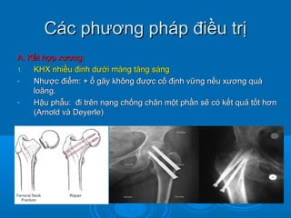 Các phương pháp điều trịCác phương pháp điều trị
A. Kết hợp xương:A. Kết hợp xương:
1.1. KHX nhiều đinh dưới màng tăng sángKHX nhiều đinh dưới màng tăng sáng
- Nhược điểm: + ổ gãy không được cố định vững nếu xương quáNhược điểm: + ổ gãy không được cố định vững nếu xương quá
loãng.loãng.
- Hậu phẫu: đi trên nạng chống chân một phần sẽ có kết quả tốt hơnHậu phẫu: đi trên nạng chống chân một phần sẽ có kết quả tốt hơn
(Arnold và Deyerle)(Arnold và Deyerle)
 