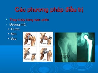 Các phương pháp điều trịCác phương pháp điều trị
 Thay khớp háng toàn phầnThay khớp háng toàn phần
- Đường mổ:Đường mổ:
+ Trước+ Trước
+ Bên+ Bên
+ Sau+ Sau
 