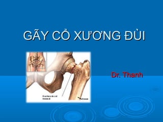 GÃY CỔ XƯƠNG ĐÙIGÃY CỔ XƯƠNG ĐÙI
Dr. ThanhDr. Thanh
 