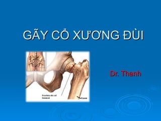 GÃY CỔ XƯƠNG ĐÙI Dr. Thanh 