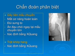 Chẩn đoán phân biệt Gãy liên mấu chuyển Mất cơ năng hoàn toàn Đùi sưng to Ấn đau chói ngay tại mấu chuyển lớn -  Xác định bằng XQuang Trật khớp háng -  Xác định bằng XQuang 