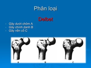 Phân loại Delbet Gãy dưới chỏm A Gãy chính danh B Gãy nền cổ C 