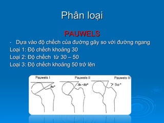 Phân loại PAUWELS Dựa vào độ chếch của đường gãy so với đường ngang Loại 1: Độ chếch khoảng 30 Loại 2: Độ chếch  từ 30 – 50 Loại 3: Độ chếch khoảng 50 trở lên 