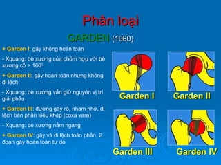 Phân loại GARDEN  (1960) Garden I    Garden II Garden III  Garden IV + Garden I : gãy không hoàn toàn - Xquang: bè xương của chỏm hợp với bè xương cổ > 160 0 + Garden II :  gãy hoàn toàn nhưng không di lệch - Xquang: bè xương vẫn giữ nguyên vị trí giải phẫu + Garden III : đường gãy rõ, nham nhở, di lệch bán phần kiểu khép (coxa vara) - Xquang: bè xương nằm ngang + Garden IV : gãy và di lệch toàn phần, 2 đoạn gãy hoàn toàn tự do 