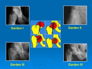 Garden I Garden III Garden II Garden IV 