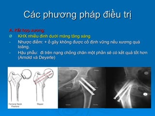 Các phương pháp điều trị A. Kết hợp xương: KHX nhiều đinh dưới màng tăng sáng Nhược điểm: + ổ gãy không được cố định vững nếu xương quá loãng. Hậu phẫu:  đi trên nạng chống chân một phần sẽ có kết quả tốt hơn (Arnold và Deyerle) 