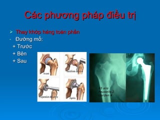 Các phương pháp điều trị Thay khớp háng toàn phần Đường mổ: + Trước + Bên + Sau 