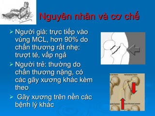 Nguyên nhân và cơ chế Người già: trực tiếp vào vùng MCL, hơn 90% do chấn thương rất nhẹ: trượt té, vấp ngả Người trẻ: thường do chấn thương nặng, có các gãy xương khác kèm theo Gãy xương trên nền các bệnh lý khác 