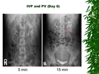 IVP and PV (Day 6) 5 min  15 min 