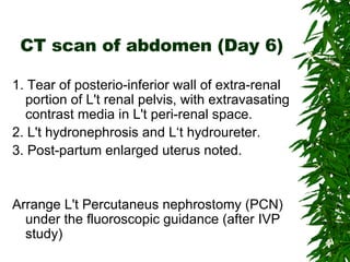 CT scan of abdomen (Day 6) 1. Tear of posterio-inferior wall of extra-renal portion of L't renal pelvis, with extravasating contrast media in L't peri-renal space. 2. L't hydronephrosis and L‘t hydroureter. 3. Post-partum enlarged uterus noted. Arrange L't Percutaneus nephrostomy (PCN) under the fluoroscopic guidance (after IVP study) 