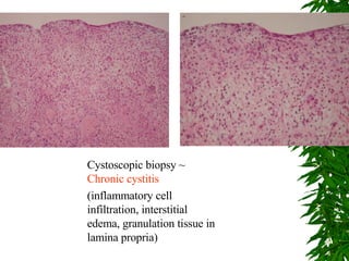 Cystoscopic biopsy ~  Chronic cystitis (inflammatory cell infiltration, interstitial edema, granulation tissue in lamina propria) 