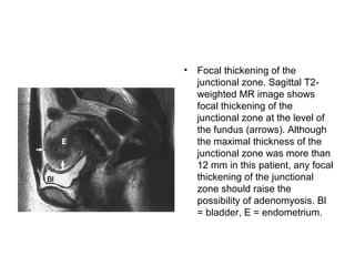 • Focal thickening of the
junctional zone. Sagittal T2-
weighted MR image shows
focal thickening of the
junctional zone at the level of
the fundus (arrows). Although
the maximal thickness of the
junctional zone was more than
12 mm in this patient, any focal
thickening of the junctional
zone should raise the
possibility of adenomyosis. Bl
= bladder, E = endometrium.
 